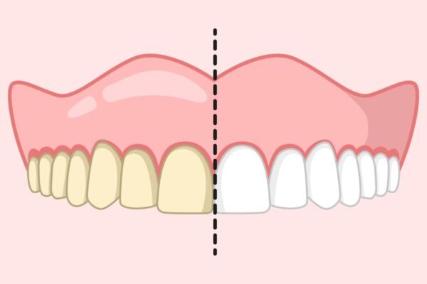Teeth Whitening, dental posters for office